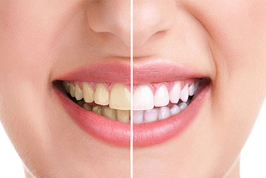 روش های طبیعی برای سفید کردن دندان ها