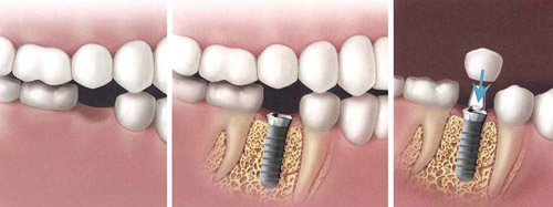 ایمپلنت ؛ مطلوب ترین جایگزین دندان های از دست رفته
