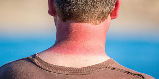 راهکارهای اورژانسی برای درمان آفتاب سوختگی