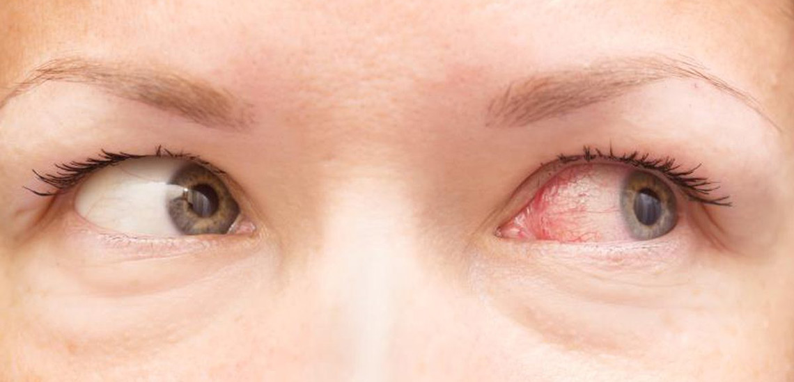 درمان خانگی عفونت چشم ، علل ایجاد و انواع آن