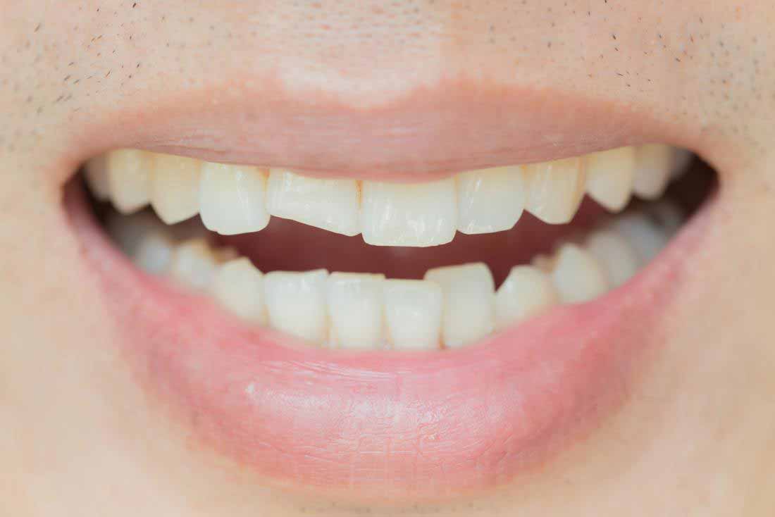 انواع ترک خوردگی دندان و راههای درمان آن