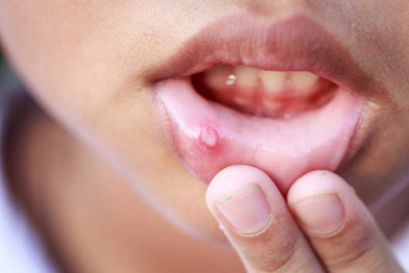 درمانهای خانگی برای آفت دهان بدون دارو