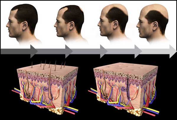 علت ریزش مو در مردان و درمان آن