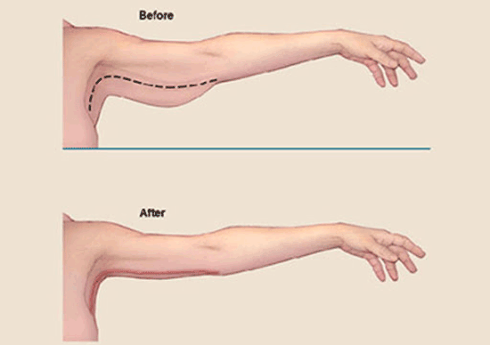 اطلاعاتی درباره لیفت بازو یا براکیوپلاستی