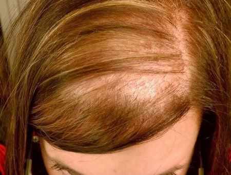 دلایل عمده ریزش موی خانمها چیست؟
