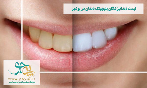 دندانپزشکان بلیچینگ دندان در بوشهر