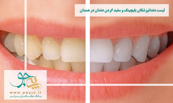 لیست دندانپزشکان بلیچینگ و سفید کردن دندان در همدان