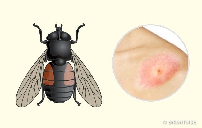 علائم ظاهری تاول و خارش جای نیش حشرات چگونه است؟