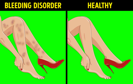 این علائم در پاها نشان دهنده مشکل در ارگانهای داخلی بدن شماست!