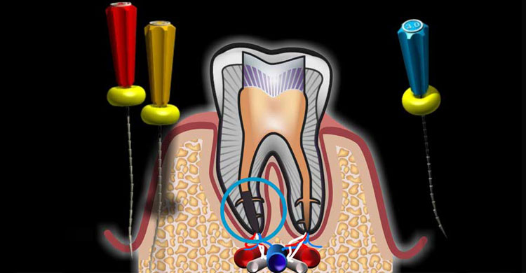 درمان ریشه دندان چگونه است؟