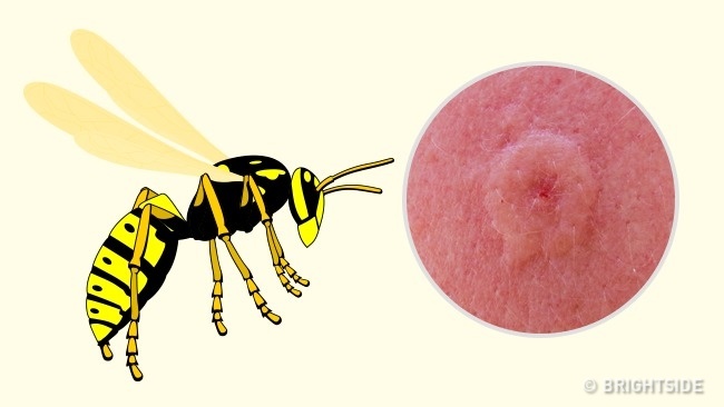 علائم ظاهری تاول و خارش جای نیش حشرات چگونه است؟