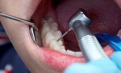 علائم نیاز به عصب کشی دندان چیست ؟
