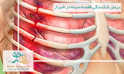 درمان شکستگی قفسه سینه در شیراز