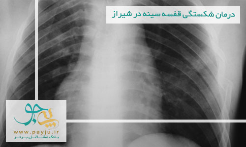 درمان شکستگی قفسه سینه در شیراز
