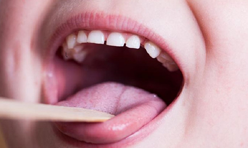 آزمايش مخاط دهان از بروز سرطان حفره دهان جلوگيري مي كند
