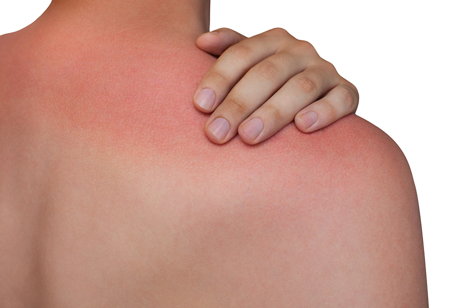 5 درمان طبیعی آسان (و موثر!) برای تسکین آفتاب سوختگی