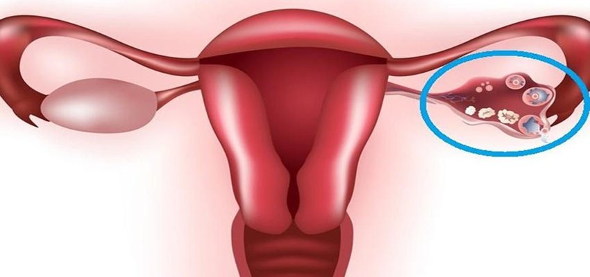 8 عارضه جانبی کنترل بارداری هورمونی که هر زنی باید بداند