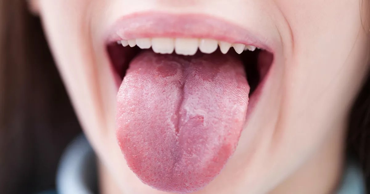 زخم زبان چه چیزی در مورد سلامتی شما نشان می دهد؟