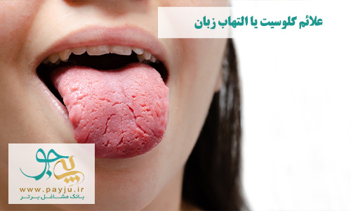 ترک خوردن (فیشور زبان) ازعلائم گلوسیت یا التهاب زبان