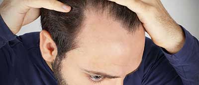 دلایل شایع ریزش موهای مردان
