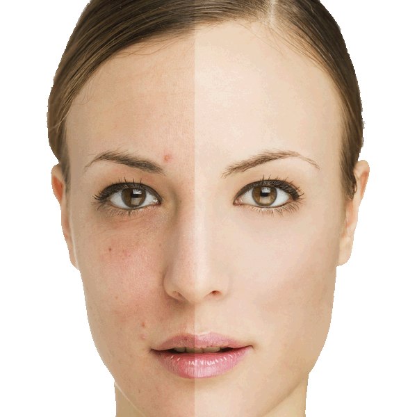 روش های خانگی برای از بین بردن لک های پوستی