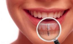 لیست دندانپزشکان متخصص ایمپلنت در شیراز