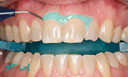 دردهای ناشی از سفید کردن دندان