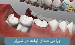جراحی دندان نهفته در شیراز
