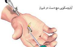آرتروسکوپی مچ دست در شیراز