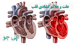 گشادی قلب: علت و علائم بزرگ شدن قلب