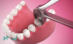 دکتر کشیدن دندان کرج