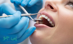دکتر پر کردن دندان قزوین
