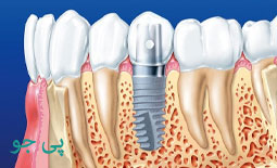 بهترین ایمپلنت دندان در تجریش