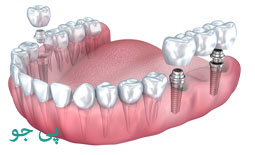 بهترین ایمپلنت دندان در جردن