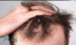 درمان ریزش مو در مرودشت
