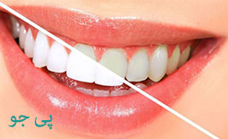 لیست دندانپزشکان متخصص بلیچینگ و سفید کردن دندان در ایلام