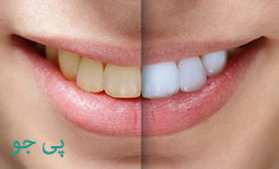 لیست دندانپزشکان بلیچینگ دندان در بوشهر - متخصص سفید کردن دندان در بوشهر