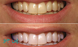 لیست دندانپزشکان متخصص بلیچینگ دندان تهران - سفید کردن دندان در تهران