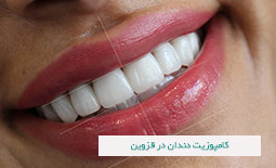 کامپوزیت دندان در قزوین