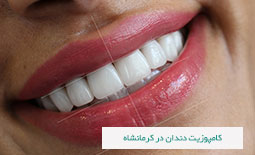 کامپوزیت دندان در کرمانشاه