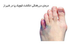 درمان دررفتگی انگشت کوچک پا در شیراز