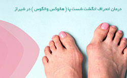 درمان انحراف انگشت شست پا ( هالوکس والگوس ) در شیراز