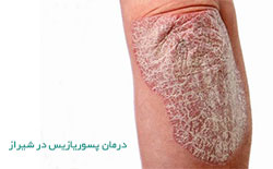 درمان پسوریازیس در شیراز