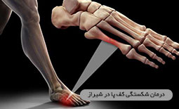 درمان شکستگی کف پا در شیراز