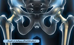 درمان شکستگی پیپکینز در شیراز