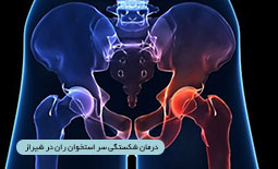 درمان شکستگی سر استخوان ران در شیراز