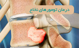 درمان تومور نخاع در شیراز