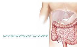 کولکتومی در شیراز - جراحی برداشتن روده بزرگ در شیراز