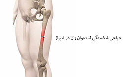 جراحی شکستگی استخوان ران در شیراز