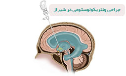 جراحی ونتریکولوستومی در شیراز